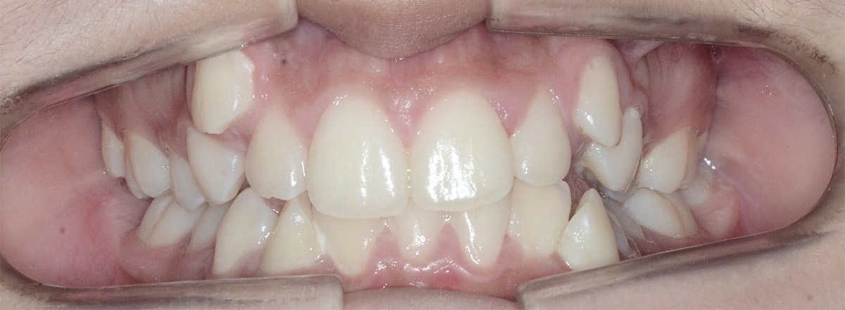 Antes de um caso clínico de Ortodontia aparelho de alinhamento nas nossas clínicas dentárias