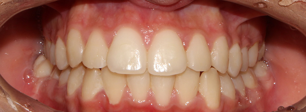 Depois de um caso clínico de Ortodontia aparelho de alinhamento nas nossas clínicas dentárias
